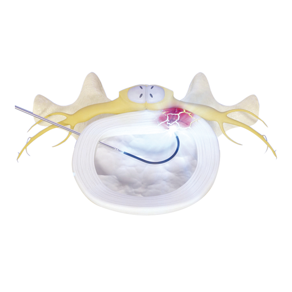 Percutaneous Discectomy Device (Edisk)